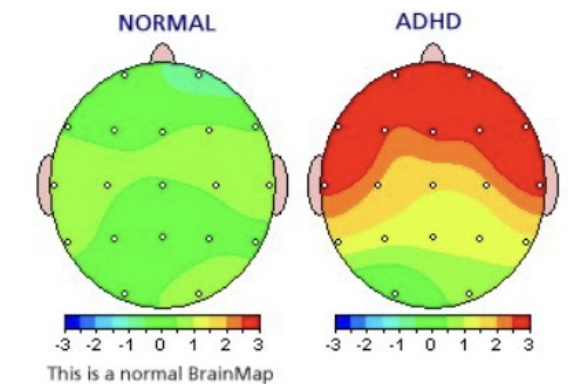 Comorbilidades del TDAH y su impacto en diagnóstico y tratamiento